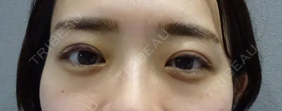 二重埋没・2点留め 7日後 メイン用