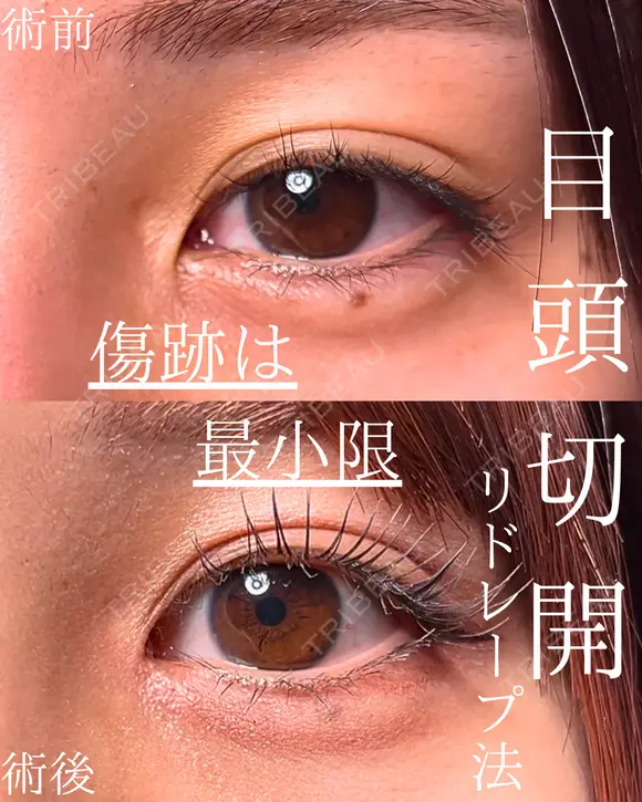 目頭切開 30日後 メイン用