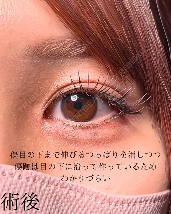 目頭切開 30日後 メイン用