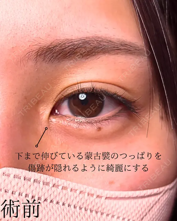 目頭切開 before画像 メイン用