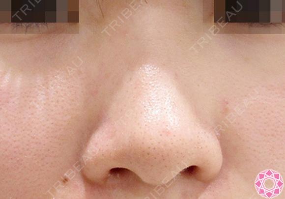 小鼻縮小　鼻翼（切開） before画像 メイン用