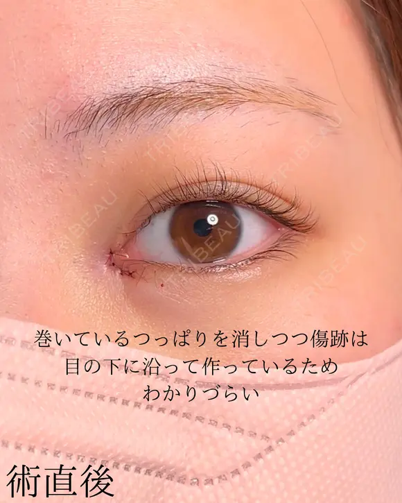 目頭切開 after画像 メイン用