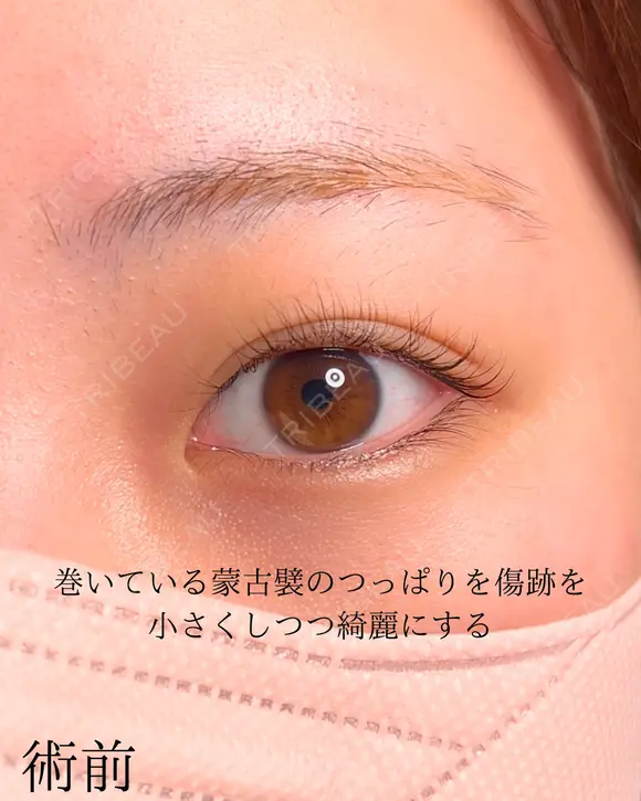 目頭切開 before画像 メイン用