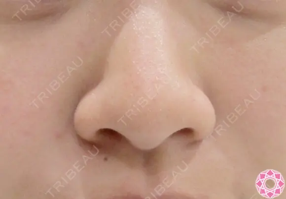 小鼻縮小　鼻翼（切開） before画像 メイン用