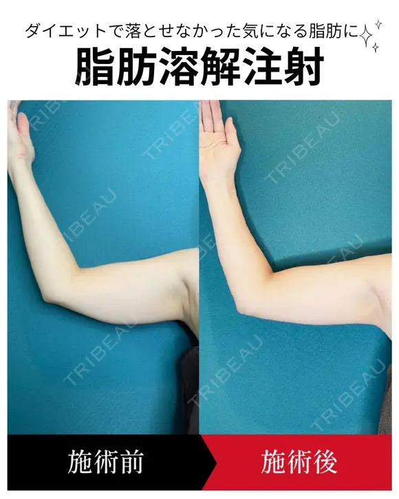 脂肪溶解注射 30日後 メイン用