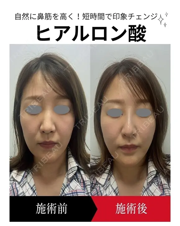ヒアルロン酸注入 0日後 メイン用