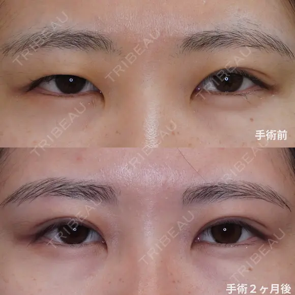 プレミアムクイック埋没法 after画像 メイン用