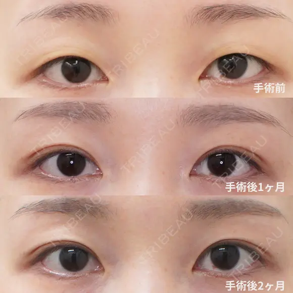プレミアクイック法 before画像 メイン用