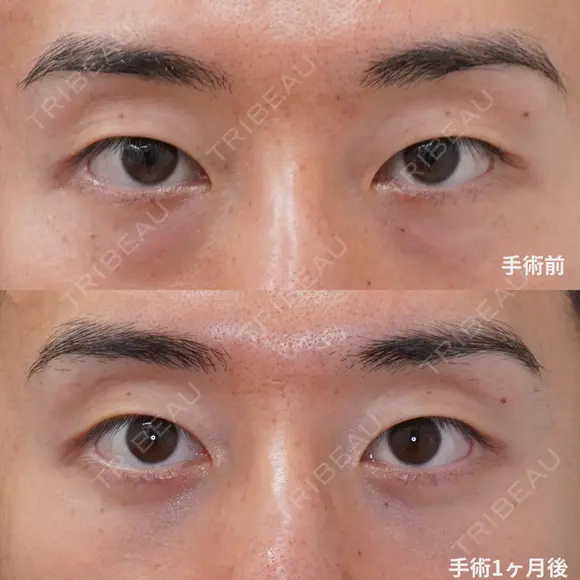 経結膜脱脂＋眼窩脂肪注入 60日後 メイン用