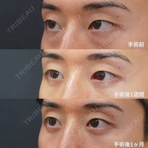 経結膜脱脂＋眼窩脂肪注入 before画像 メイン用