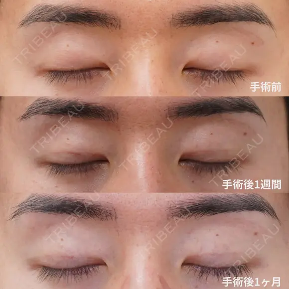 二重埋没　プレミアムクイック法 before画像 メイン用