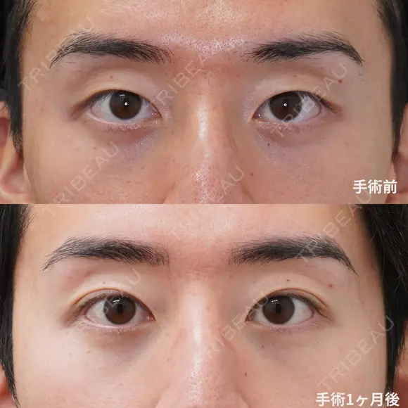 二重埋没　プレミアムクイック法 30日後 メイン用
