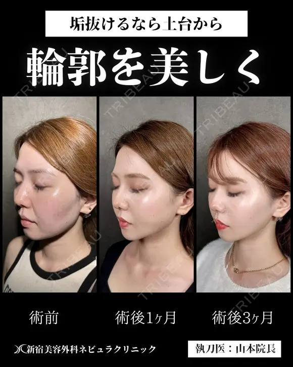 山本医師による🎀小顔脂肪吸引🎀 before画像 メイン用