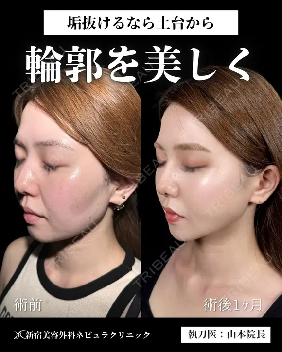 山本医師による🎀小顔脂肪吸引🎀 after画像 メイン用