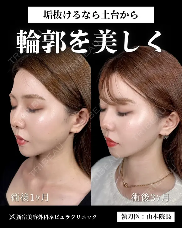 山本医師による🎀小顔脂肪吸引🎀 after画像 メイン用