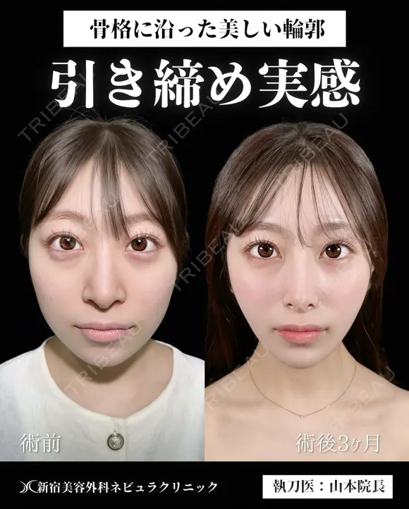 山本医師による🎀小顔脂肪吸引🎀 before画像 メイン用