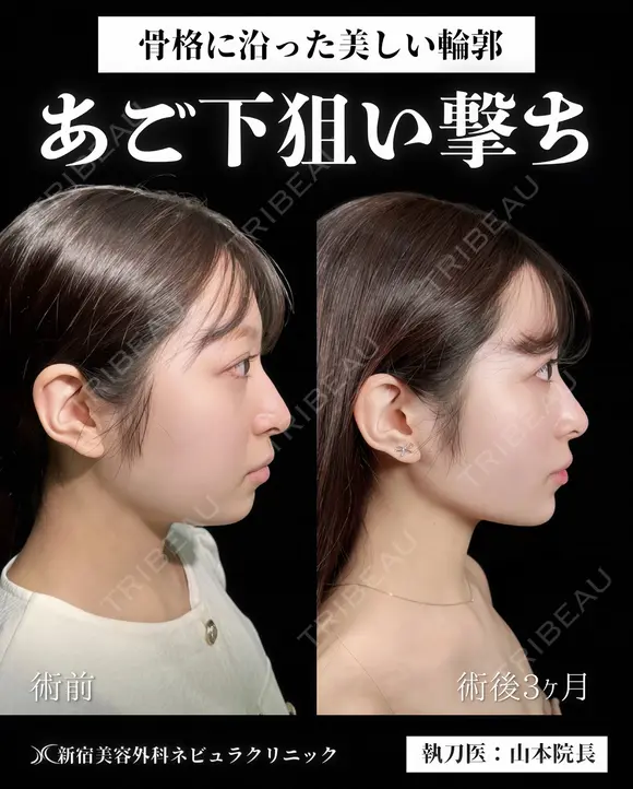 山本医師による🎀小顔脂肪吸引🎀 after画像 メイン用