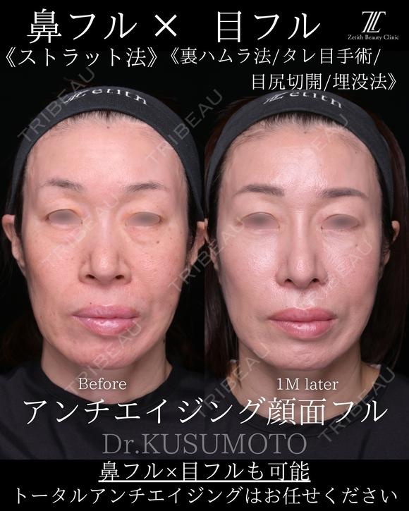 鼻フル28万〜 before画像 メイン用
