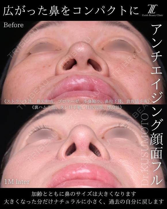 鼻フル28万〜 after画像 メイン用