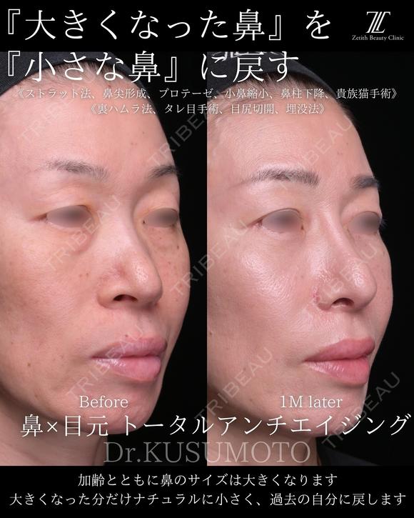 鼻フル28万〜 after画像 メイン用