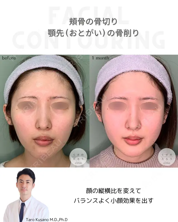 ほほ（頬骨）骨切り&顎先（おとがい）骨削り before画像 メイン用