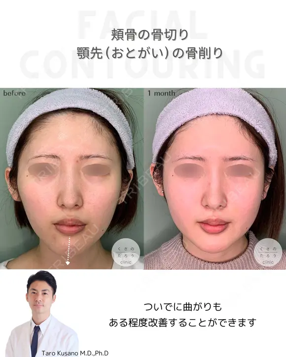 ほほ（頬骨）骨切り&顎先（おとがい）骨削り 30日後 メイン用