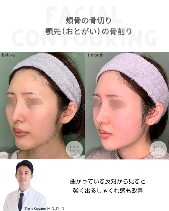 ほほ（頬骨）骨切り&顎先（おとがい）骨削り 30日後 メイン用