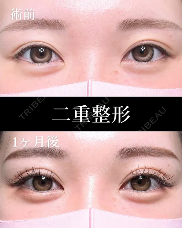 二重埋没法 30日後 メイン用