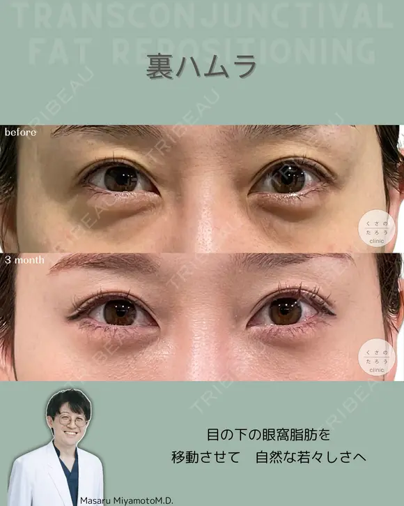 裏ハムラ before画像 メイン用