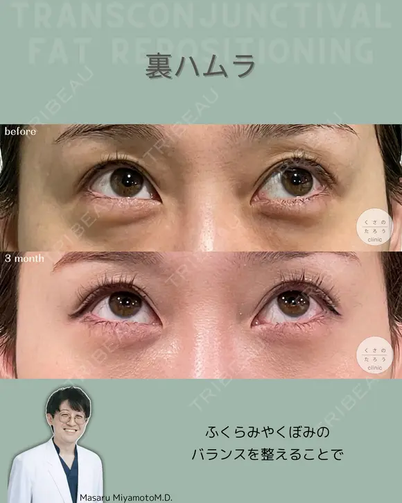 裏ハムラ 90日後 メイン用