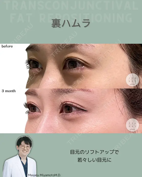 裏ハムラ 90日後 メイン用
