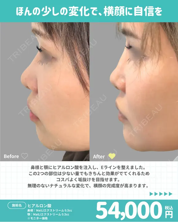 鼻根・顎ヒアルロン酸 before画像 メイン用