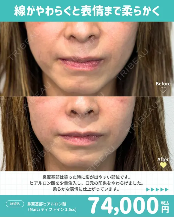 鼻翼基部 ヒアルロン酸 before画像 メイン用