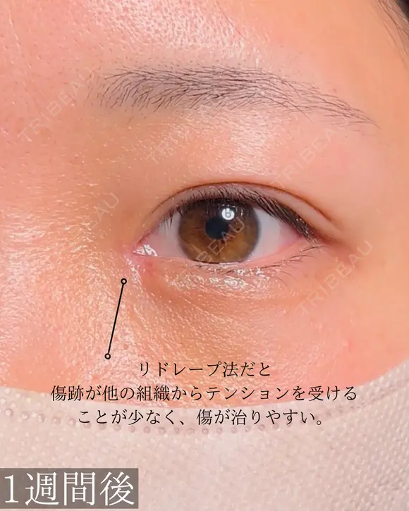 目頭切開 7日後 メイン用