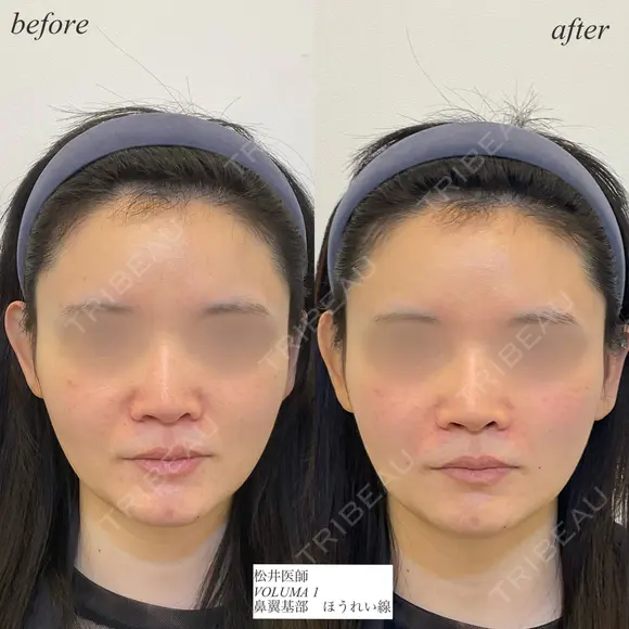 鼻翼基部　ほうれい線ヒアルロン酸 before画像 メイン用