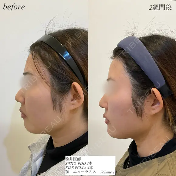 糸リフト　顎ヒアルロン酸 after画像 メイン用