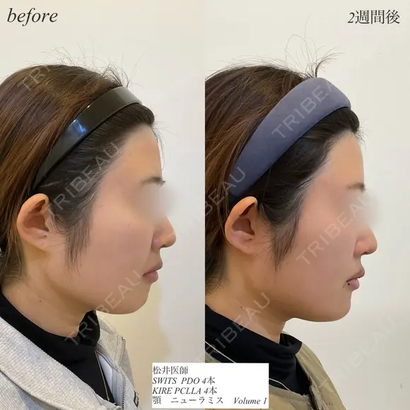 糸リフト　顎ヒアルロン酸 after画像 メイン用