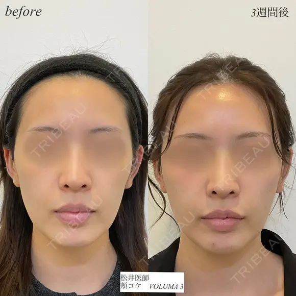 頬コケヒアルロン酸 before画像 メイン用