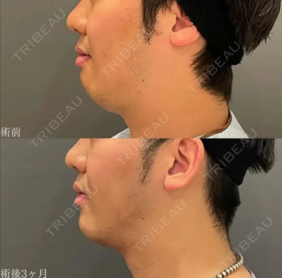 複合治療でフェイスライン形成🌴脂肪吸引（頬・顎下）+ヒアルロン酸注入（顎）+ボツラックス（顎）注入✨ after画像 メイン用
