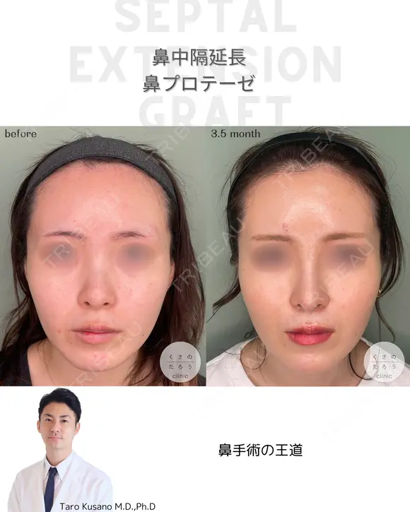 鼻中隔延長&鼻プロテーゼ before画像 メイン用