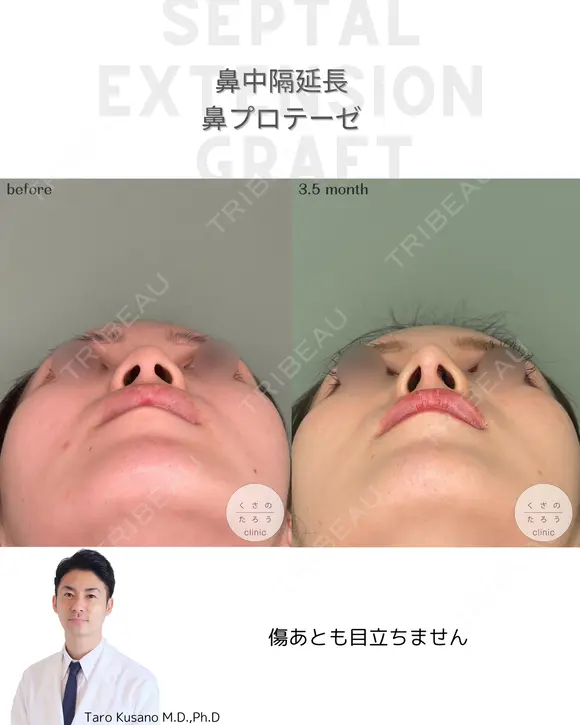鼻中隔延長&鼻プロテーゼ 105日後 メイン用