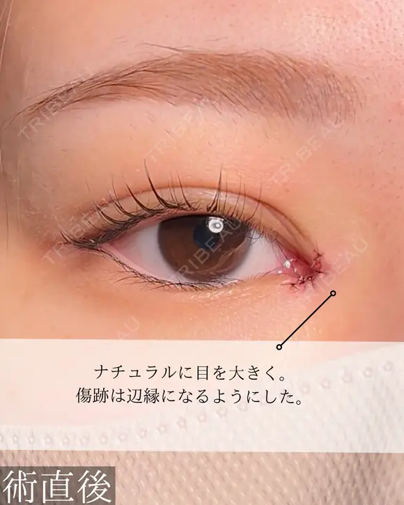 目頭切開 0日後 メイン用