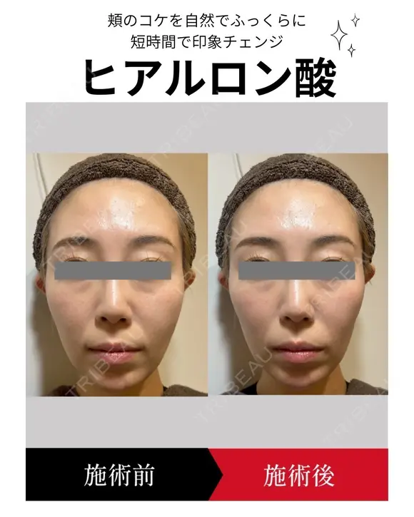 ヒアルロン酸注入 before画像 メイン用