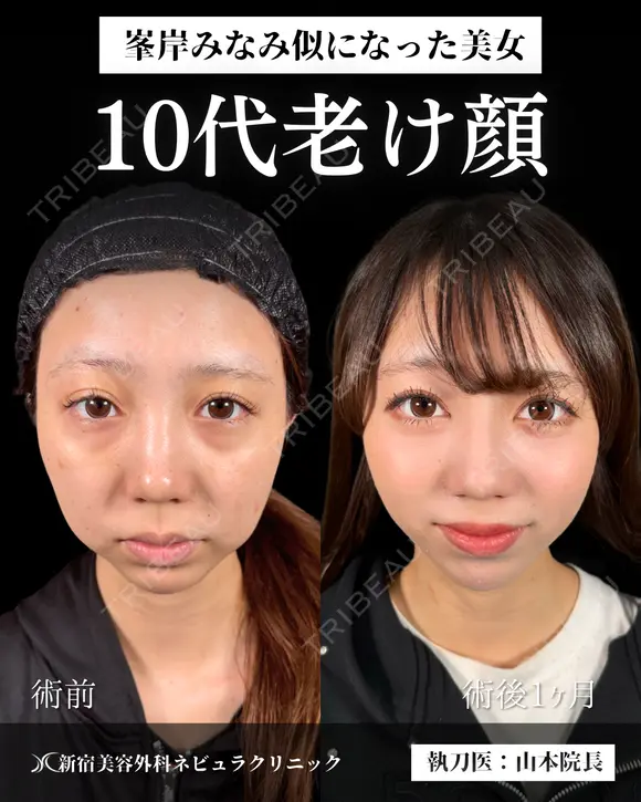 山本医師による🎀小顔脂肪吸引🎀 after画像 メイン用