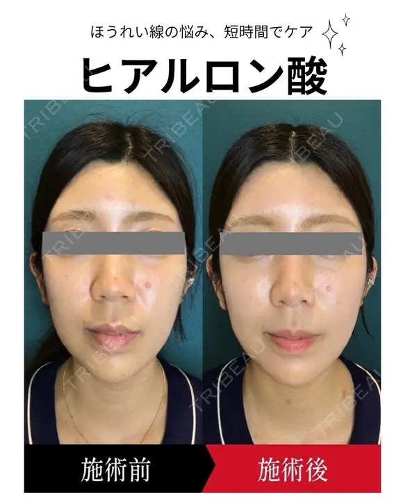 ヒアルロン酸注入 before画像 メイン用