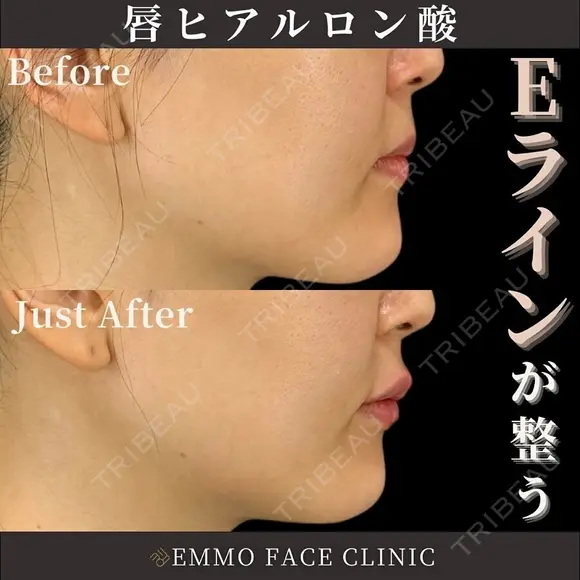 ヒアルロン酸（唇） after画像 メイン用