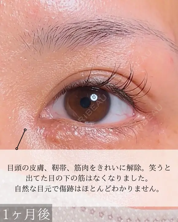 目頭切開 30日後 メイン用