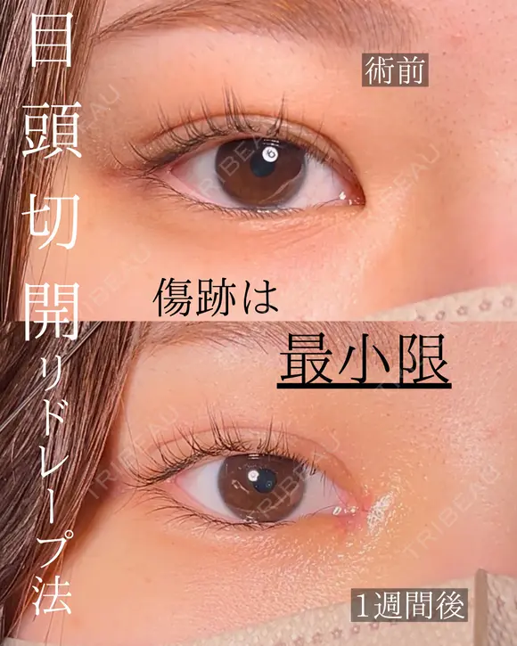 目頭切開 after画像 メイン用
