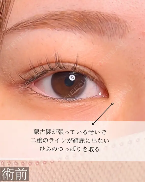 目頭切開 before画像 メイン用