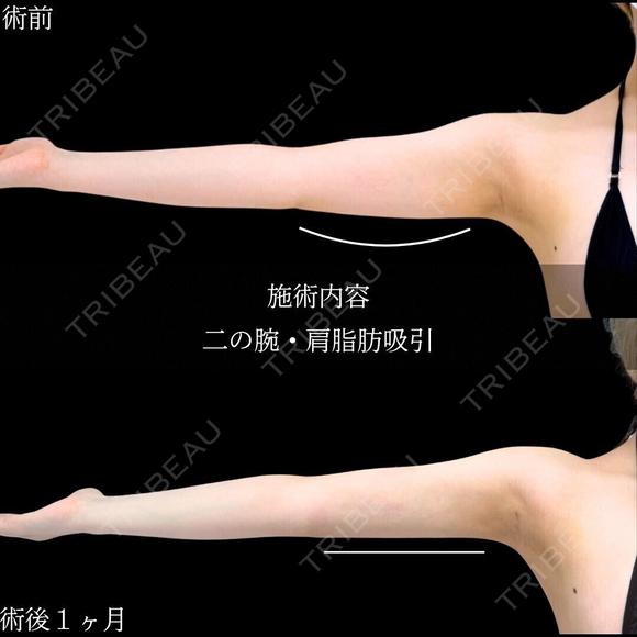 二の腕　肩　脂肪吸引 before画像 メイン用